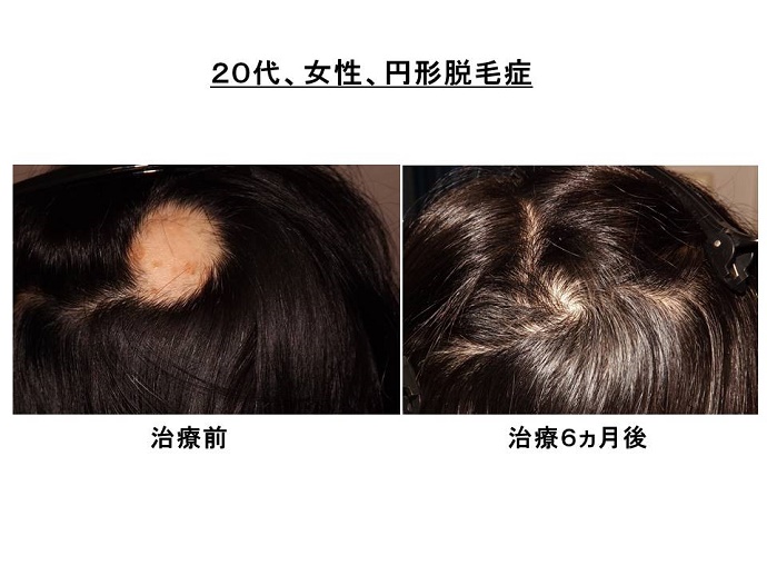 円形脱毛症　病院""